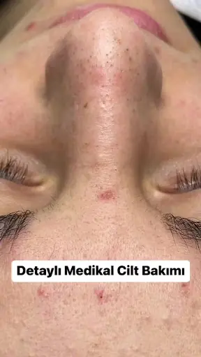 Elegans Güzellik Salonu | Buz Lazer Epilasyon | Soprano Titanium | Cilt Bakımı | G5 Masajı 4