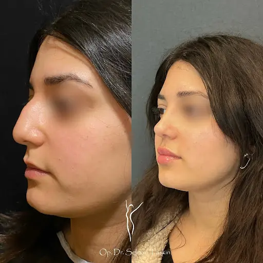 TSHEALTH | Dental & Plastic & Cosmetic Surgery | Implant & Cosmetic Dentistry | Buz & Soprano & Alexandrite Lazer Epilasyon 2
