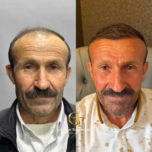 GÖKHAN TURANLIOĞLU SAÇ EKİM MERKEZİ 2