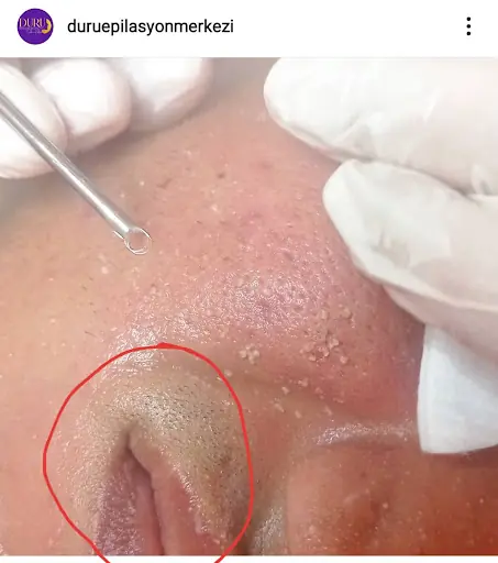 Düziçi Duru Lazer Epilasyon Merkezi 4