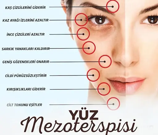 Dr. Mehtap Uysal. Botoks Mezoterapi Dolgu 2