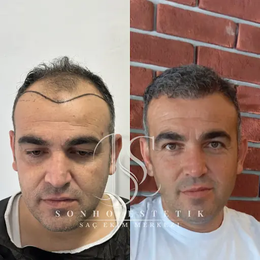 Sonho Estetik | Adana Saç Ekimi 4