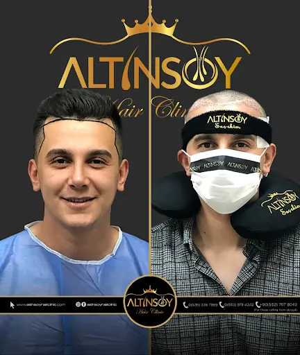 Trabzon Saç Ekim Merkezi Saç PRP`si | Altınsoy Hair Clinic