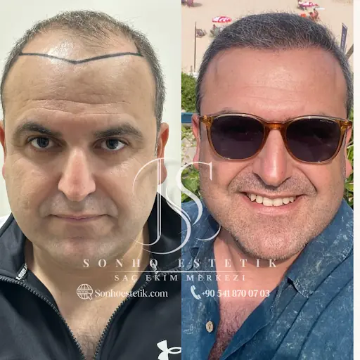 Sonho Estetik | Adana Saç Ekimi 3