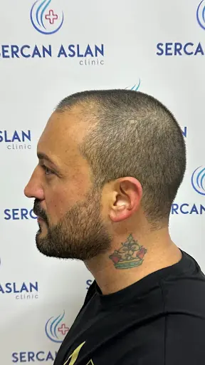 Sercan Aslan - Hair Transplant Turkey 3