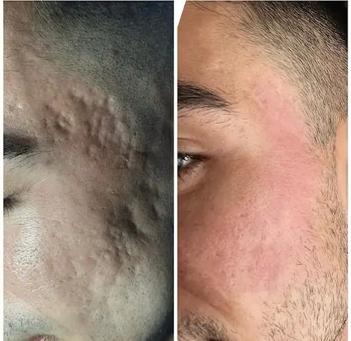 ENZA BEAUTY | LEVENT | KAĞITHANE | GÜZELLİK MERKEZİ | LAZER EPİLASYON | CİLT BAKIMI | ZAYIFLAMA