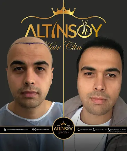Trabzon Saç Ekim Merkezi Saç PRP`si | Altınsoy Hair Clinic 2