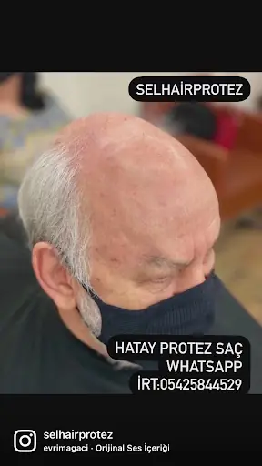 Sel Hair Protez 4