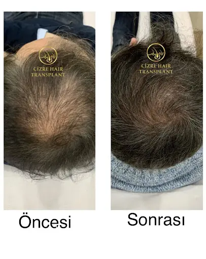 Cizre saç ekimi