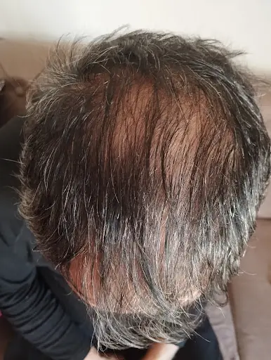 Değişim Saç Ekim Merkezi Ağrı