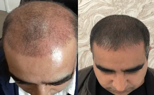 Bayburt Saç Ekim Merkezi