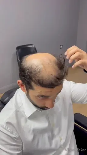 Kadir coşkun hair& protez saç 3
