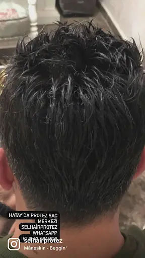 Sel Hair Protez 3
