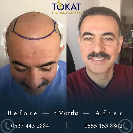 Tokat Saç Ekimi Merkezi | Tokat Hair Clinic 2