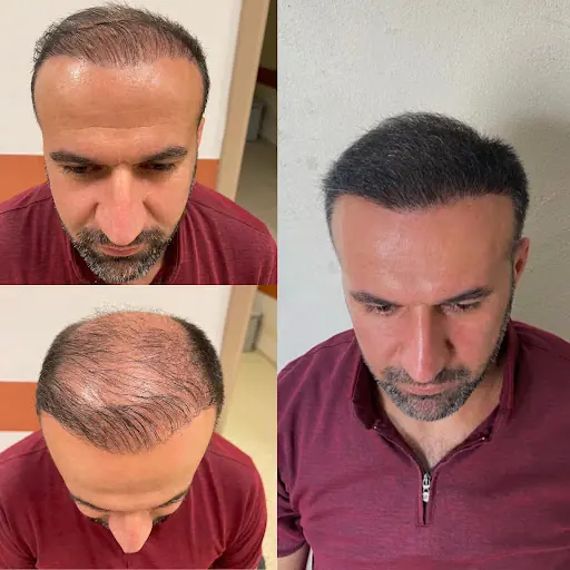 SİLOPİ SAÇ EKİM MERKEZİ