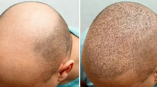 Trabzon Saç Ekim Merkezi - Hair Clinic