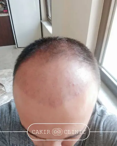 Gemlik Saç Ekim Merkezi 2