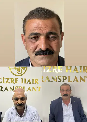Cizre saç ekimi 2