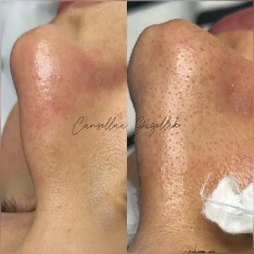 Cansellaa Güzellik İğneli Epilasyon Bahçeşehir Ispartakule 2