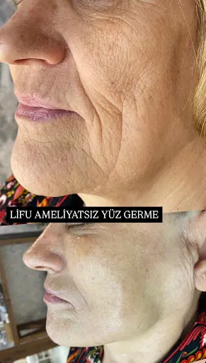 EBRU METE ESTETİK & LİPOSONİX MERKEZİ 4