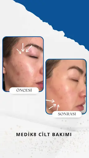 Ülkü Keleş | Microblading | Kaş Tasarımı | İğneli Epilasyon | Kaş Laminasyonu | Kalıcı Makyaj | Cilt Bakımı | Kirpik Lifting 4