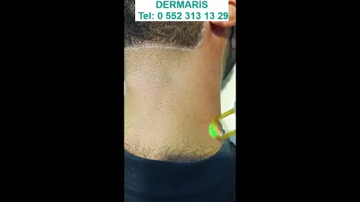 Dermaris Lazer Epilasyon Merkezi 4